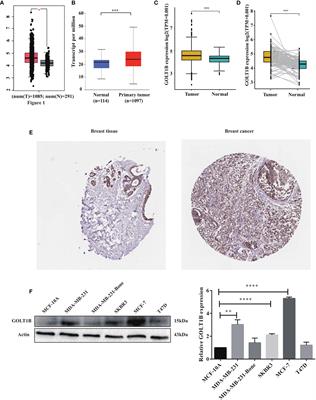 Multi-Omics Analyses Revealed GOLT1B as a Potential Prognostic Gene in Breast Cancer Probably Regulating the Immune Microenvironment